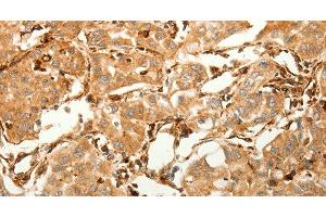 Immunohistochemistry of paraffin-embedded Human lung cancer tissue using SFRP1 Polyclonal Antibody at dilution 1:80 (SFRP1 抗体)