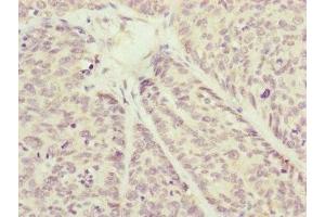 Immunohistochemistry of paraffin-embedded human ovarian cancer using ABIN7149183 at dilution of 1:100 (COX7A2L 抗体  (AA 1-114))