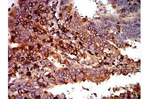 Immunohistochemical analysis of paraffin-embedded endometrial cancer tissues using C3C mouse mAb with DAB staining. (Complement C3c 抗体  (AA 1521-1649))