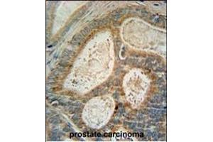 INSIG1 Antibody (N-term) (ABIN652887 and ABIN2842574) immunohistochemistry analysis in formalin fixed and paraffin embedded human prostate carcinoma followed by peroxidase conjugation of the secondary antibody and DAB staining. (INSIG1 抗体  (N-Term))