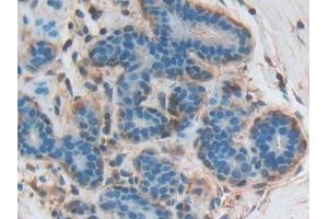 DAB staining on IHC-P; Samples: Human Breast cancer Tissue (CNTNAP1 抗体  (AA 926-1190))