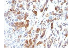 Formalin-fixed, paraffin-embedded human gastric carcinoma stained with MUC5 antibody (MUC5AC/917). (MUC5AC 抗体)