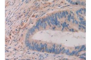 Detection of ATF4 in Human Colorectal cancer Tissue using Polyclonal Antibody to Activating Transcription Factor 4 (ATF4)