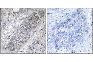 Immunohistochemistry analysis of paraffin-embedded human breast carcinoma tissue, using 4E-BP1 (Ab-45) Antibody. (eIF4EBP1 抗体  (AA 13-62))