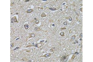 Immunohistochemistry of paraffin-embedded Human brain cancer using WIPI1 Polyclonal Antibody at dilution of 1:100 (40x lens). (WIPI1 抗体)