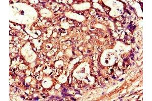 Immunohistochemistry of paraffin-embedded human gastric cancer using ABIN7173790 at dilution of 1:100 (RANKL 抗体  (AA 73-306))