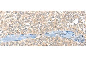Immunohistochemistry of paraffin-embedded Human ovarian cancer tissue using SNX6 Polyclonal Antibody at dilution of 1:40(x200) (SNX6 抗体)