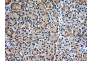Immunohistochemical staining of paraffin-embedded Adenocarcinoma of Human ovary tissue using anti-PDE4A mouse monoclonal antibody. (PDE4A 抗体)