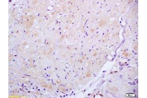 Formalin-fixed and paraffin embedded human gastric carcinoma labeled with Anti ROCK2 Polyclonal Antibody, Unconjugated (ABIN673359) at 1:200 followed by conjugation to the secondary antibody and DAB staining (ROCK2 抗体  (AA 1001-1300))