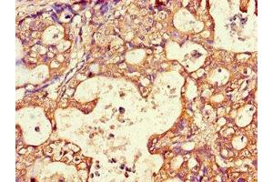 Immunohistochemistry of paraffin-embedded human gastric cancer using ABIN7144511 at dilution of 1:100 (AQP3 抗体  (AA 210-244))