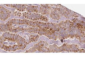 ABIN6273336 at 1/100 staining Human thyroid cancer tissue by IHC-P. (TSH receptor 抗体  (Internal Region))