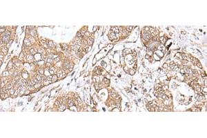 Immunohistochemistry of paraffin-embedded Human gastric cancer tissue using TEAD2 Polyclonal Antibody at dilution of 1:60(x200) (TEAD2 抗体)