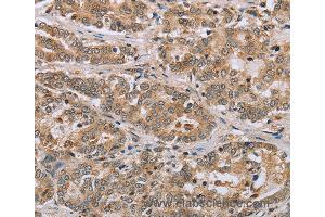 Immunohistochemistry of Human liver cancer using CLEC16A Polyclonal Antibody at dilution of 1:45 (CLEC16A 抗体)