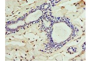 Immunohistochemistry of paraffin-embedded human breast cancer using ABIN7147563 at dilution of 1:100 (ALG1 抗体  (AA 215-464))