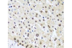 Immunohistochemistry of paraffin-embedded Human liver damage using FUBP1 Polyclonal Antibody at dilution of 1:100 (40x lens). (FUBP1 抗体)