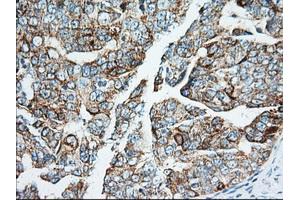 Immunohistochemical staining of paraffin-embedded Adenocarcinoma of Human breast tissue using anti-IGF2BP2 mouse monoclonal antibody. (IGF2BP2 抗体)