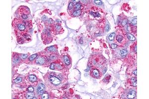 Anti-GPR161 antibody IHC of human Lung, Adenocarcinoma. (GPR161 抗体  (C-Term))