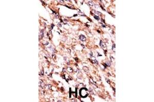 Formalin-fixed and paraffin-embedded human cancer tissue reacted with the primary antibody, which was peroxidase-conjugated to the secondary antibody, followed by AEC staining. (BCKDK 抗体  (AA 120-151))