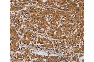 Immunohistochemistry of Human lung cancer using RAB8A Polyclonal Antibody at dilution of 1:45