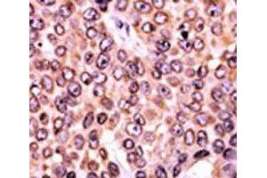 IHC analysis of FFPE human breast carcinoma tissue stained with the p-p21 antibody. (p21 抗体  (pThr145))