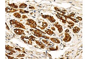 ABIN6257226 and ABIN6274237 at 1/100 staining Human pancreatic cancer by IHC-P.