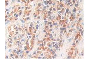 IHC-P analysis of Human Prostate Gland Cancer Tissue, with DAB staining. (Kallikrein 11 抗体  (AA 39-282))