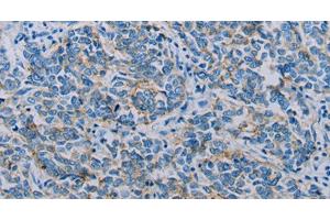 Immunohistochemistry of paraffin-embedded Human breast cancer using Claudin 4 Polyclonal Antibody at dilution of 1:35 (Claudin 4 抗体)