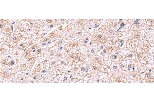 Immunohistochemistry of paraffin-embedded Human liver cancer tissue using PDRG1 Polyclonal Antibody at dilution of 1:75(x200) (PDRG1 抗体)