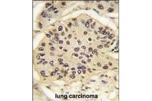 Formalin-fixed and paraffin-embedded human lung carcinoma tissue reacted with SOX2 Antibody (ABIN387798 and ABIN2843854) , which was peroxidase-conjugated to the secondary antibody, followed by DAB staining. (SOX2 抗体)