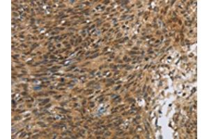 The image on the left is immunohistochemistry of paraffin-embedded Human cervical cancer tissue using ABIN7190675(FOXB1 Antibody) at dilution 1/30, on the right is treated with synthetic peptide. (FOXB1 抗体)