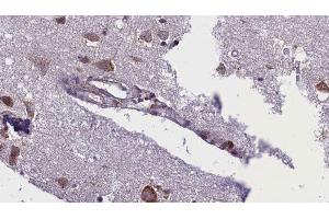 ABIN6276388 at 1/100 staining Human brain cancer tissue by IHC-P.