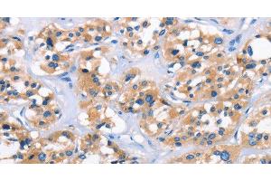Immunohistochemistry of paraffin-embedded Human thyroid cancer tissue using APOL6 Polyclonal Antibody at dilution 1:50 (APOL6 抗体)