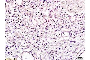 Formalin-fixed and paraffin embedded human gastric carcinoma labeled with Anti CHMP1A Polyclonal Antibody, Unconjugated (ABIN705236) at 1:200 followed by conjugation to the secondary antibody and DAB staining