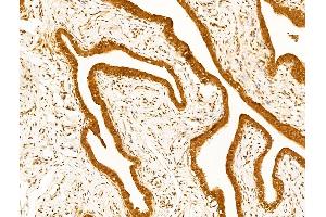 ABIN7094791 and ABIN7098842 at 1/100 staining Human kidney cancer by IHC-P. (UBA1 抗体  (Internal Region))