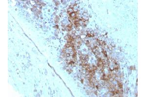 Formalin-fixed, paraffin-embedded human Melanoma stained with CD63 Mouse Monoclonal Antibody (LAMP3/2789). (CD63 抗体  (AA 100-197))