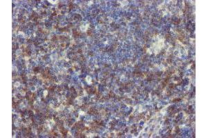 Immunohistochemical staining of paraffin-embedded Human lymphoma tissue using anti-NMT2 mouse monoclonal antibody. (NMT2 抗体)