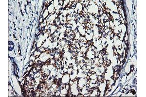 Immunohistochemical staining of paraffin-embedded Adenocarcinoma of Human breast tissue using anti-ERBB2 mouse monoclonal antibody. (ErbB2/Her2 抗体  (AA 676-1255))