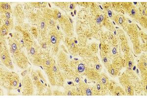 Immunohistochemistry of paraffin-embedded Human liver damage using TXNL1 Polyclonal Antibody at dilution of 1:100 (40x lens). (TXNL1 抗体)