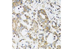 Immunohistochemistry of paraffin-embedded human colon carcinoma using EPB41 antibody (ABIN1872554) at dilution of 1:100 (40x lens). (EPB41 抗体)