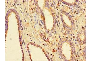 Immunohistochemistry of paraffin-embedded human prostate cancer using ABIN7160076 at dilution of 1:100 (BUB3 抗体  (AA 6-217))