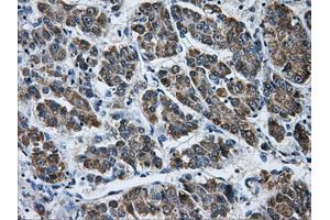 Immunohistochemical staining of paraffin-embedded Carcinoma of liver tissue using anti-AKR1A1mouse monoclonal antibody. (AKR1A1 抗体)