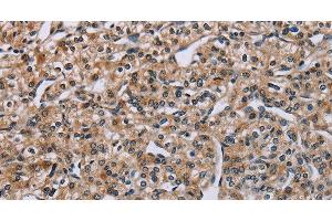 Immunohistochemistry of paraffin-embedded Human prostate cancer tissue using PNPT1 Polyclonal Antibody at dilution 1:40 (PNPT1 抗体)