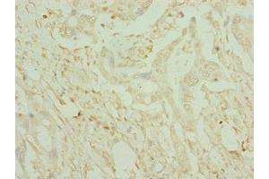 Immunohistochemistry of paraffin-embedded human pancreatic cancer using ABIN7149016 at dilution of 1:100 (CDO1 抗体  (AA 1-200))