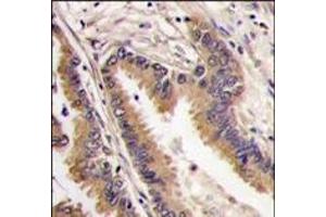 Formalin-fixed and paraffin-embedded human lung carcinoma tissue reacted with ERK4 antibody (C-term), which was peroxidase-conjugated to the secondary antibody, followed by DAB staining. (MAPK4 抗体  (C-Term))
