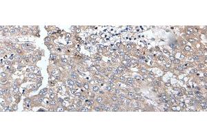 Immunohistochemistry of paraffin-embedded Human liver cancer tissue using BRMS1L Polyclonal Antibody at dilution of 1:45(x200) (BRMS1L 抗体)