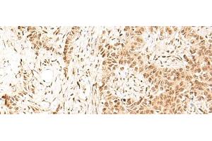 Immunohistochemistry of paraffin-embedded Human ovarian cancer tissue using HIST1H1D Polyclonal Antibody at dilution of 1:55(x200) (Histone H1.3 抗体)