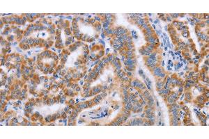 Immunohistochemistry of paraffin-embedded Human thyroid cancer tissue using BST1 Polyclonal Antibody at dilution 1:50 (BST1 抗体)