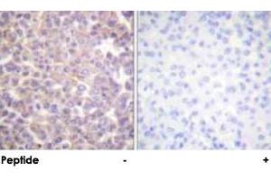 Immunohistochemical analysis of paraffin-embedded human breast carcinoma tissue using ERBB3 polyclonal antibody . (ERBB3 抗体)