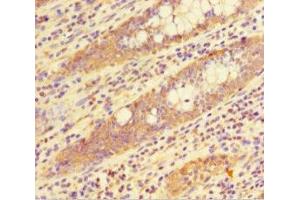 Immunohistochemistry of paraffin-embedded human colon cancer using ABIN7155348 at dilution of 1:100 (HIST1H1C 抗体  (AA 2-213))