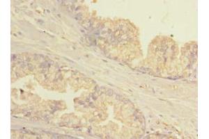 Immunohistochemistry of paraffin-embedded human prostate cancer using ABIN7154781 at dilution of 1:100 (GBP5 抗体  (AA 321-500))